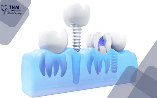Nhổ răng vỡ thân, thay thế bằng răng cấy ghép Implant nha khoa