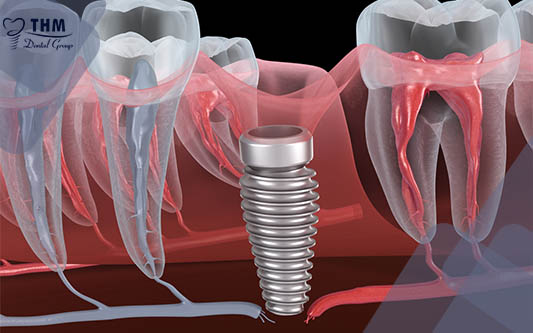 Nhổ răng vỡ thân, thay thế bằng răng cấy ghép Implant nha khoa