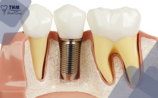 5 Nhược điểm của phương pháp cắm chân răng nhân tạo Implant 