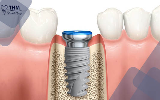 5 Nhược điểm của phương pháp cắm chân răng nhân tạo Implant 
