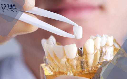 Giải thích lý do không phục hình răng sứ trên Implant luôn mà phải đợi đến 3-4 tháng?