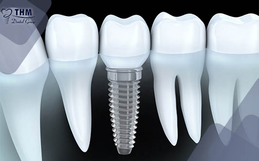 Giải thích lý do không phục hình răng sứ trên Implant luôn mà phải đợi đến 3-4 tháng?