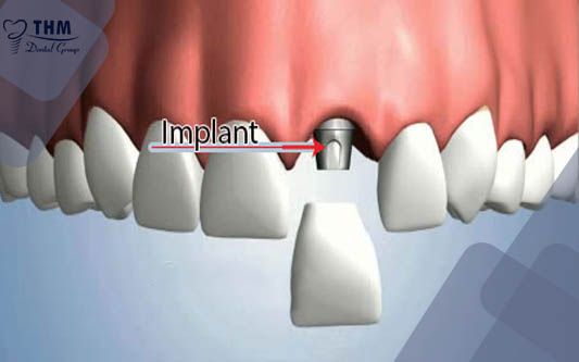 Phục hồi răng cửa bằng Răng Implant trong nha khoa