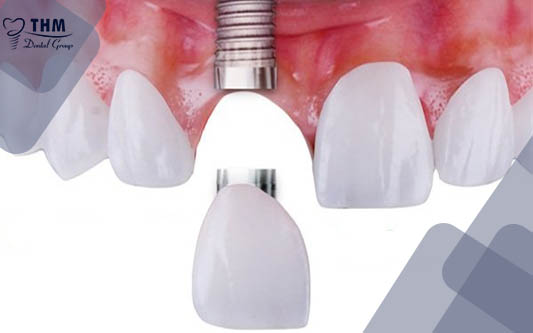Phục hồi răng cửa bằng Răng Implant trong nha khoa