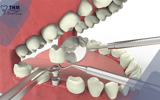 Quá trình lắp răng sứ trên trụ Implant mất bao lâu?