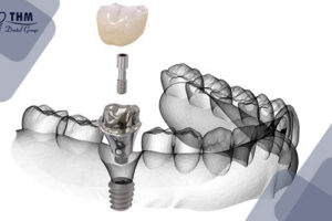 Bảng giá 111 Quá trình lắp răng sứ trên trụ Implant mất bao lâu?
