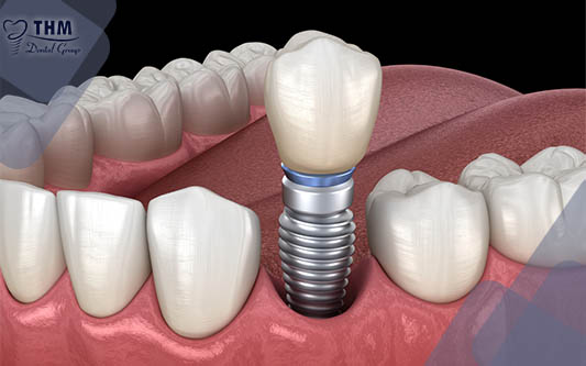 Quá trình lắp răng sứ trên trụ Implant mất bao lâu?