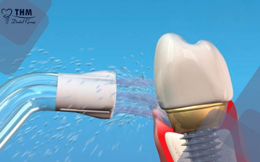Răng Implant bị dắt thức ăn nguyên nhân và cách khắc phục