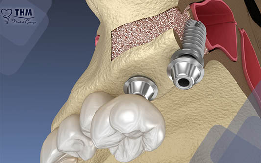 Nguyên nhân tại sao răng Implant bị đào thải khi cấy vào xương
