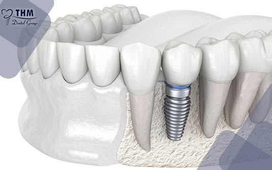 Nguyên nhân tại sao răng Implant bị đào thải khi cấy vào xương