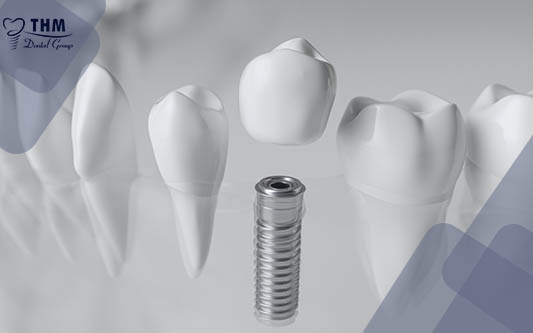 Tái tạo răng sứ trên Implant là gì? Quy trình thực hiện như thế nào?
