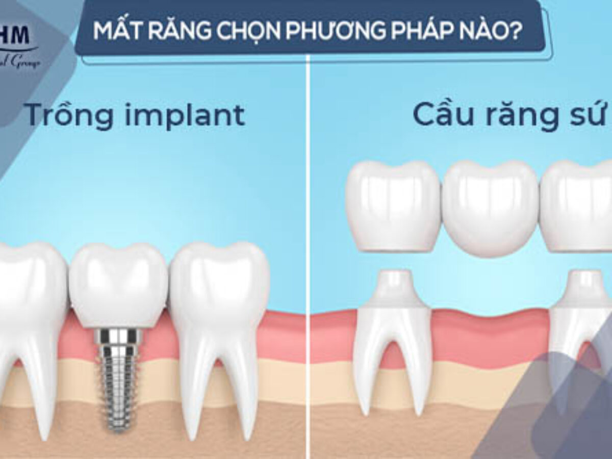 Trồng Răng Sứ Khi Bị Mất Răng: Giải Pháp Hoàn Hảo Cho Nụ Cười Và Sức Khỏe