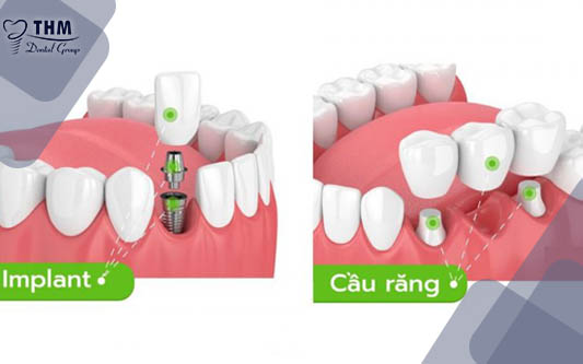 Nếu bị mất răng nên trồng Implant hay làm cầu răng sứ?
