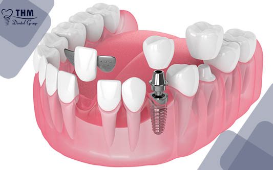 Nếu bị mất răng nên trồng Implant hay làm cầu răng sứ?