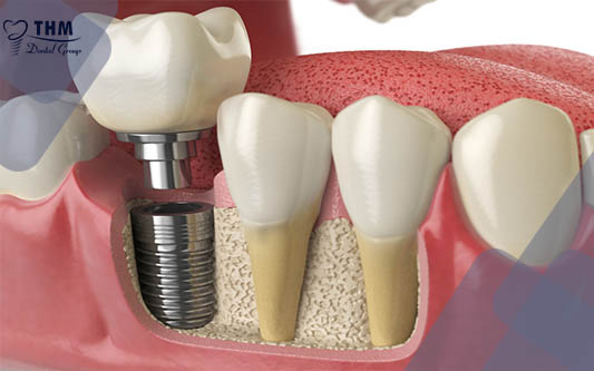 Trồng Implant Răng Hàm - Răng chắc khỏe, ăn nhai tốt