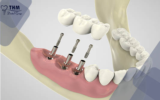Trồng Implant Răng Hàm - Răng chắc khỏe, ăn nhai tốt