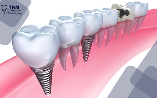 Trồng răng Implant cho người không răng bẩm sinh