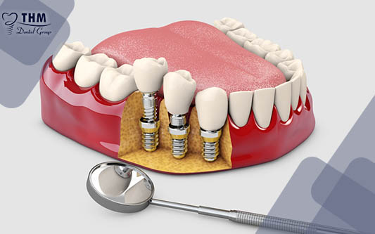 Trồng răng Implant có nguy hiểm hay không?