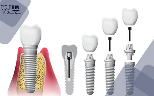 Trồng răng Implant loại nào tốt nhất và ở đâu uy tín nhất?
