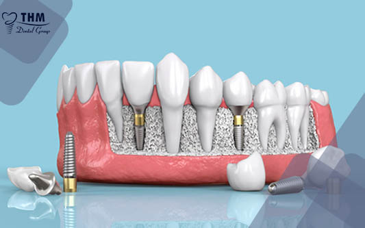 Trồng răng Implant loại nào tốt nhất và ở đâu uy tín nhất?
