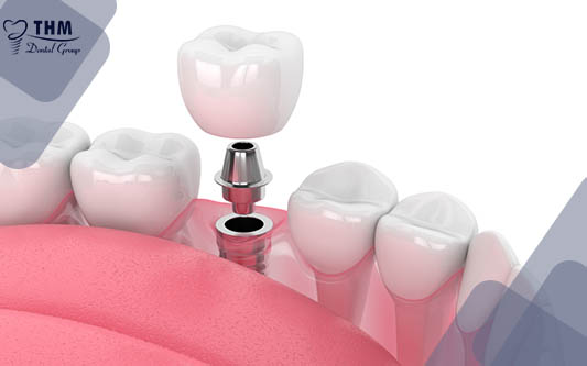 Trồng răng Implant ở đâu tốt nhất ?