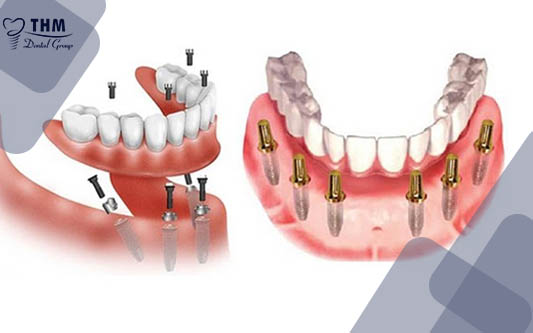 Trồng răng Implant ở đâu tốt nhất ?