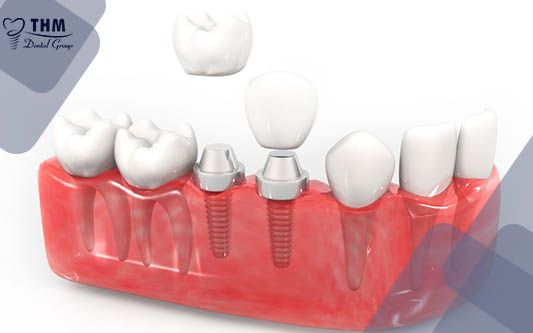 Trồng răng Implant ở đâu uy tín ?