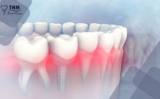 Trồng răng Implant ở đâu uy tín ?