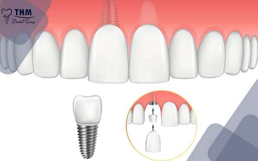 Trồng răng implant răng cửa có ghép xương là gì?