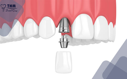 Trồng răng implant răng cửa có ghép xương là gì?