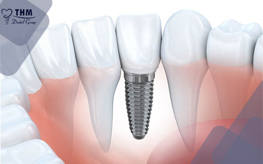 Tỷ Lệ Thất Bại của Trồng Răng Implant là bao nhiêu trong 2021?