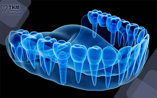 Tỷ Lệ Thất Bại của Trồng Răng Implant là bao nhiêu trong 2021?