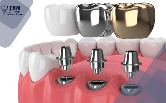 Yếu tố kéo dài tuổi thọ khi trồng răng Implant gồm những gì?