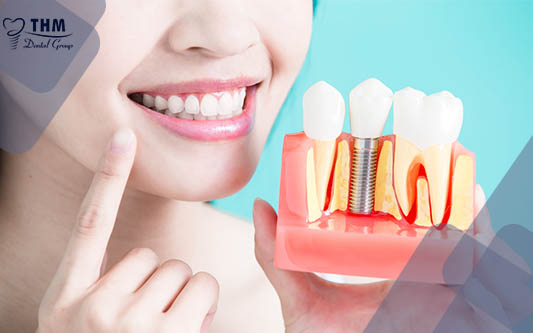 Yếu tố kéo dài tuổi thọ khi trồng răng Implant gồm những gì?