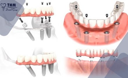 Bảng giá trồng răng Implant mới nhất năm 2021