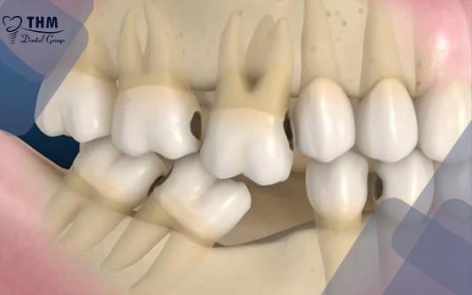 Trồng răng implant trả góp tại nha khoa Thế Hệ Mới