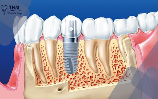 Răng implant bị lung lay và những điều cần biết