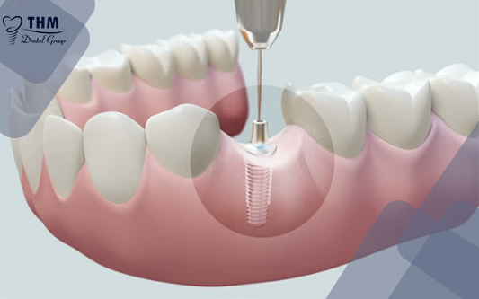 Địa chỉ cấy ghép răng implant an toàn nhất 2021