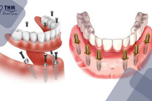 Bảng giá 106 Cấy ghép implant all on 6 là gì? Có nên cấy ghép all on 6 không?