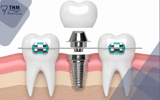 [ 2021] Trồng răng implant có niềng được không? 