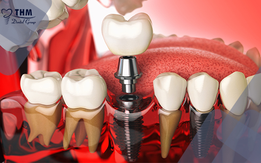 Răng implant bị lung lay và những điều cần biết