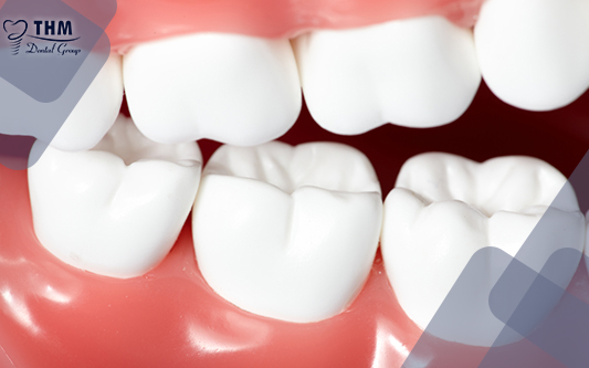 Cầu răng sứ với răng giống y như răng thật từ vẻ bề ngoài đến chức năng nhai