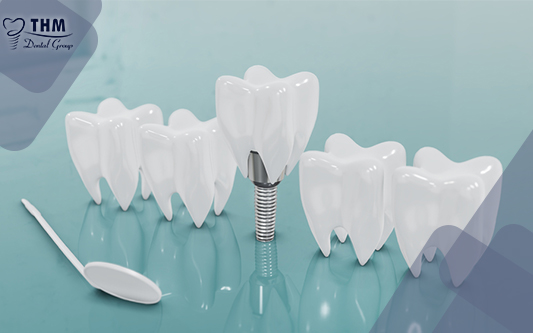 Bảng giá trồng răng implant là vấn đề rất nhiều người quan tâm