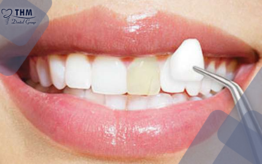 Bọc răng sứ cho răng hô giúp răng trắng sáng tự nhiên