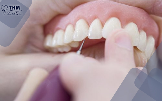 Bọc răng sứ có hết hô không – giải đáp cùng Nha khoa thế hệ mới