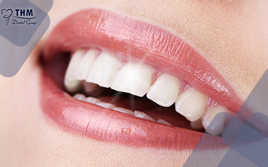 Bọc răng sứ được bao nhiêu năm phụ thuộc vào nhiều yếu tố
