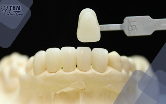 Bọc răng sứ giải pháp phục hình răng được áp dụng rộng rãi