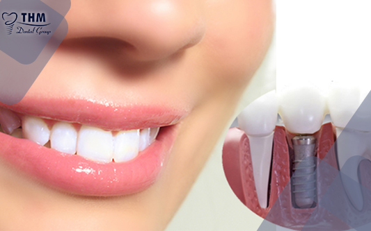 Bọc răng sứ implant giúp cải thiện hàm răng của bạn