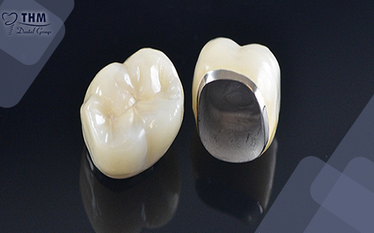 Bọc răng sứ kim loại là nguyên nhân hàng đầu của vấn đề bị đen viền nướu 