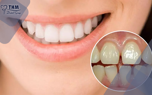 Bọc răng sứ là phương pháp xử lý hàm răng khi không thẳng đều, răng thưa hay bị mẻ, gãy